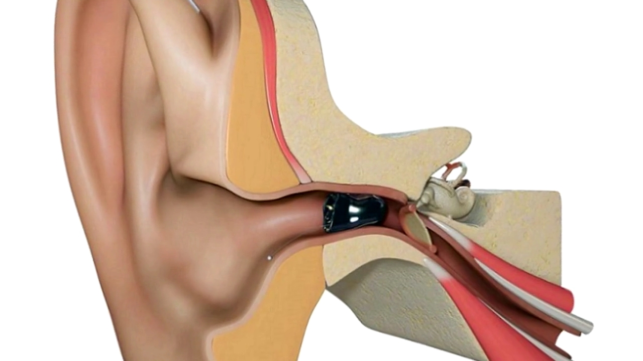 Внутриканальные слуховые аппараты. Преимущества и недостатки  внутриканальных аппаратов