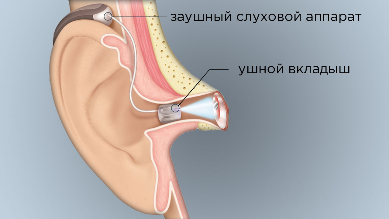 Заушные слуховые аппараты